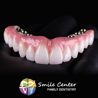 Hybrid Implant Bridge