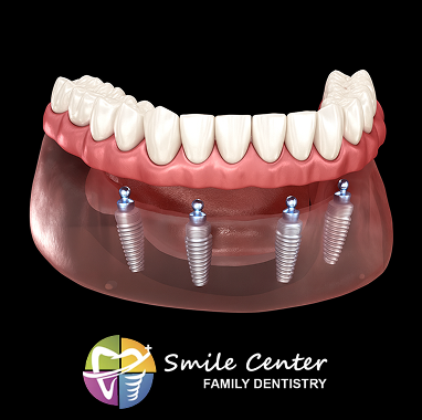 Zirconia Implant Bridge